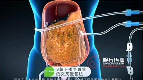 医疗器械动画，让腔体热灌注系统的治疗原理不再难懂