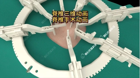 脊椎手术动画天花板！细节拉满