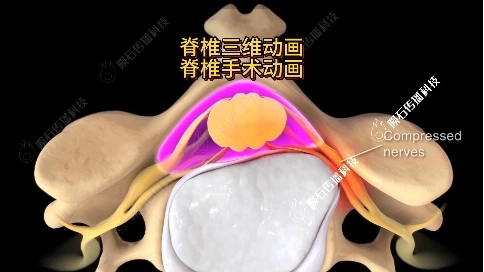 强烈推荐！脊椎手术动画精准拆解流程
